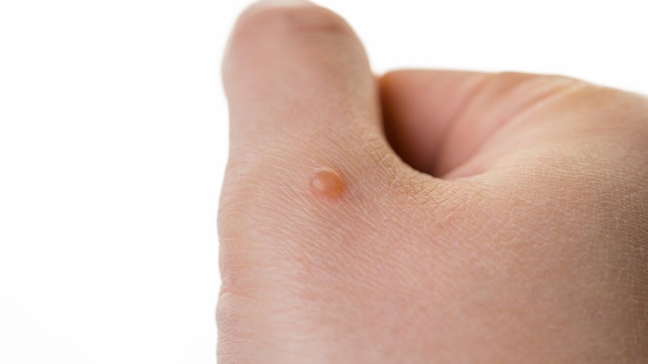 Neophagus on the arm