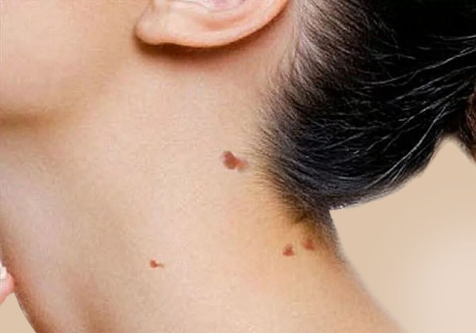 The appearance of papillomas on the neck after the activation of HPV in the body