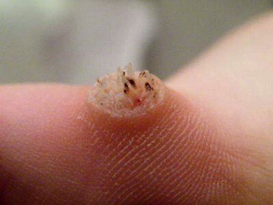 wart on the skin how to treat