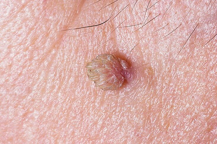 A wart on the skin that can be removed in several ways