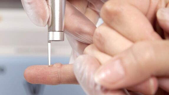 One of the methods for removing warts is the use of laser. 