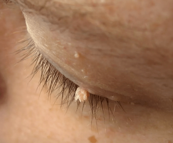 Papilloma movie