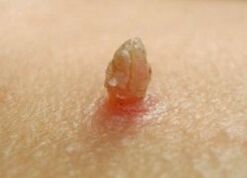 Bright papilloma