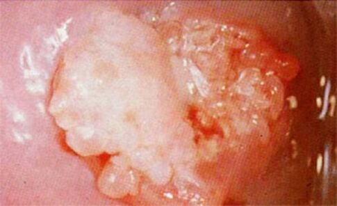 Canto of the cervix