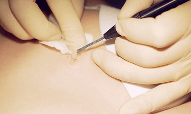 Surgical elimination of the plantar wart
