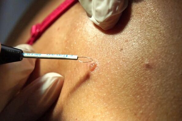 Removal of papillomas by the radio wave method