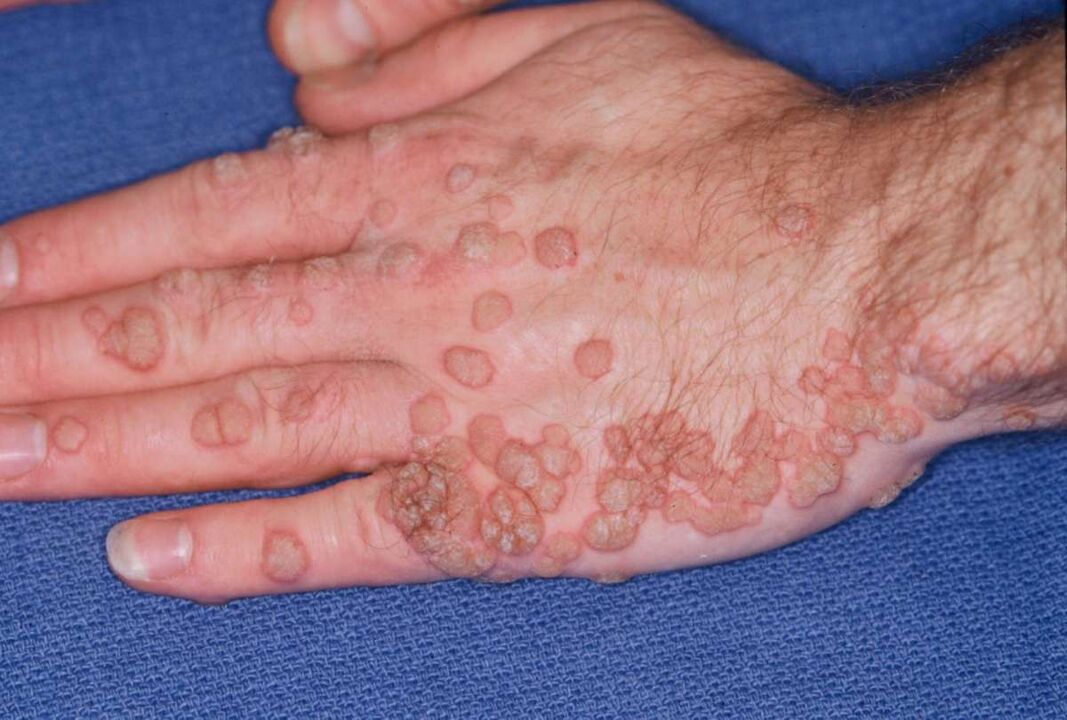 a lot of papillomas on the hands