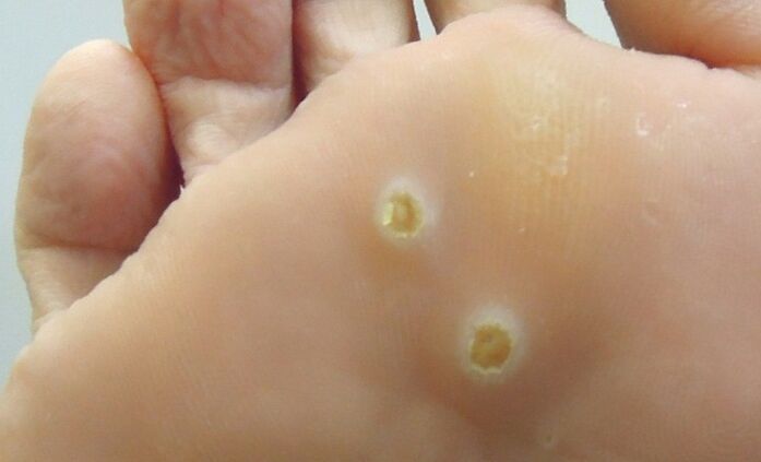 plantar papillomas of the foot
