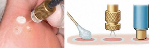 cryodestruction as a method of removing papillomas