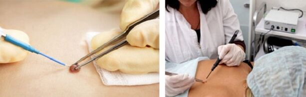 electrocoagulation as a means of removing papillomas