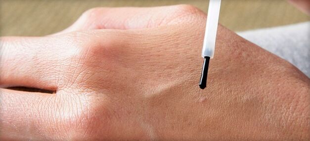 treatment of warts with medication