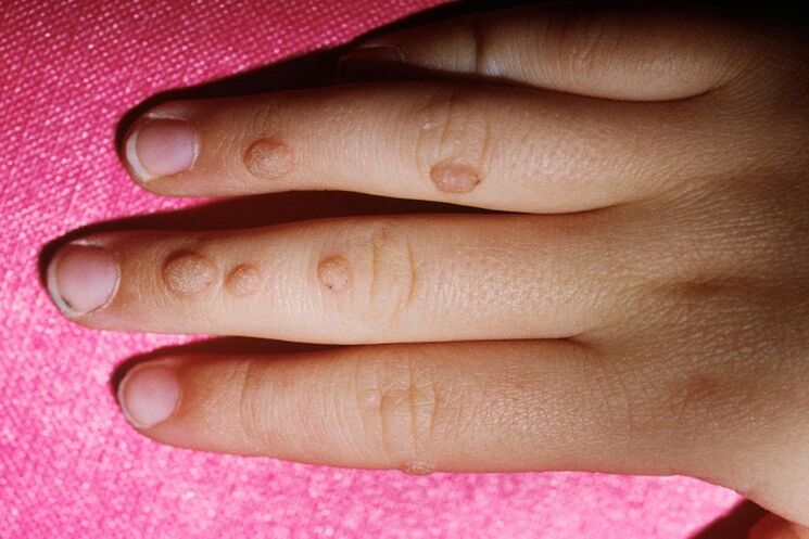 common warts on fingers
